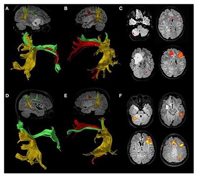 Perspectives on (A)symmetry of Arcuate Fasciculus. A Short Review About Anatomy, Tractography and TMS for Arcuate Fasciculus Reconstruction in Planning Surgery for Gliomas in Language Areas